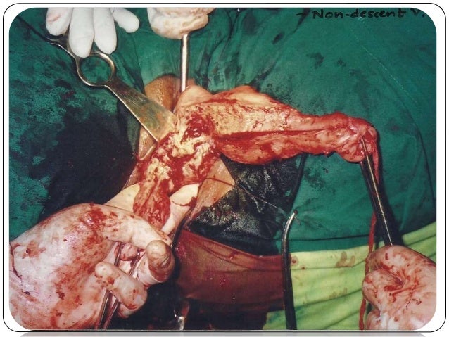 post op vaginal hysterectomy Post op vaginal hysterectomy